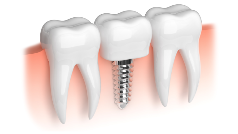 Dental Implants near Sylvan gGrove, KS